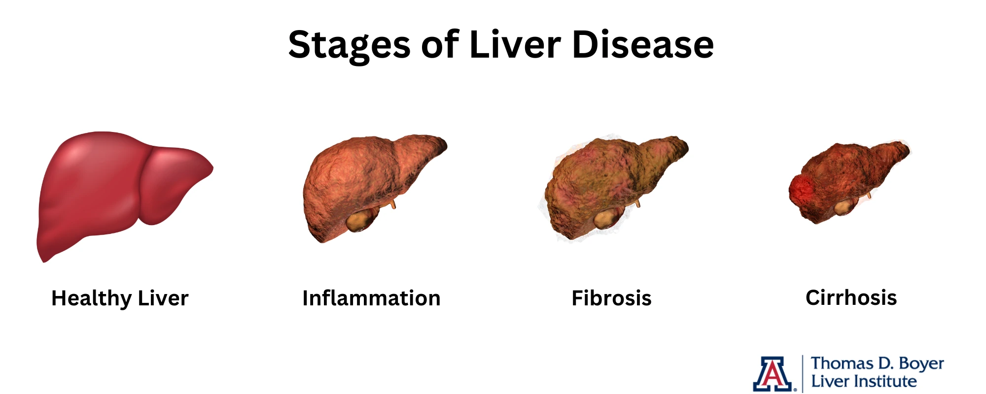 stages of liver disease